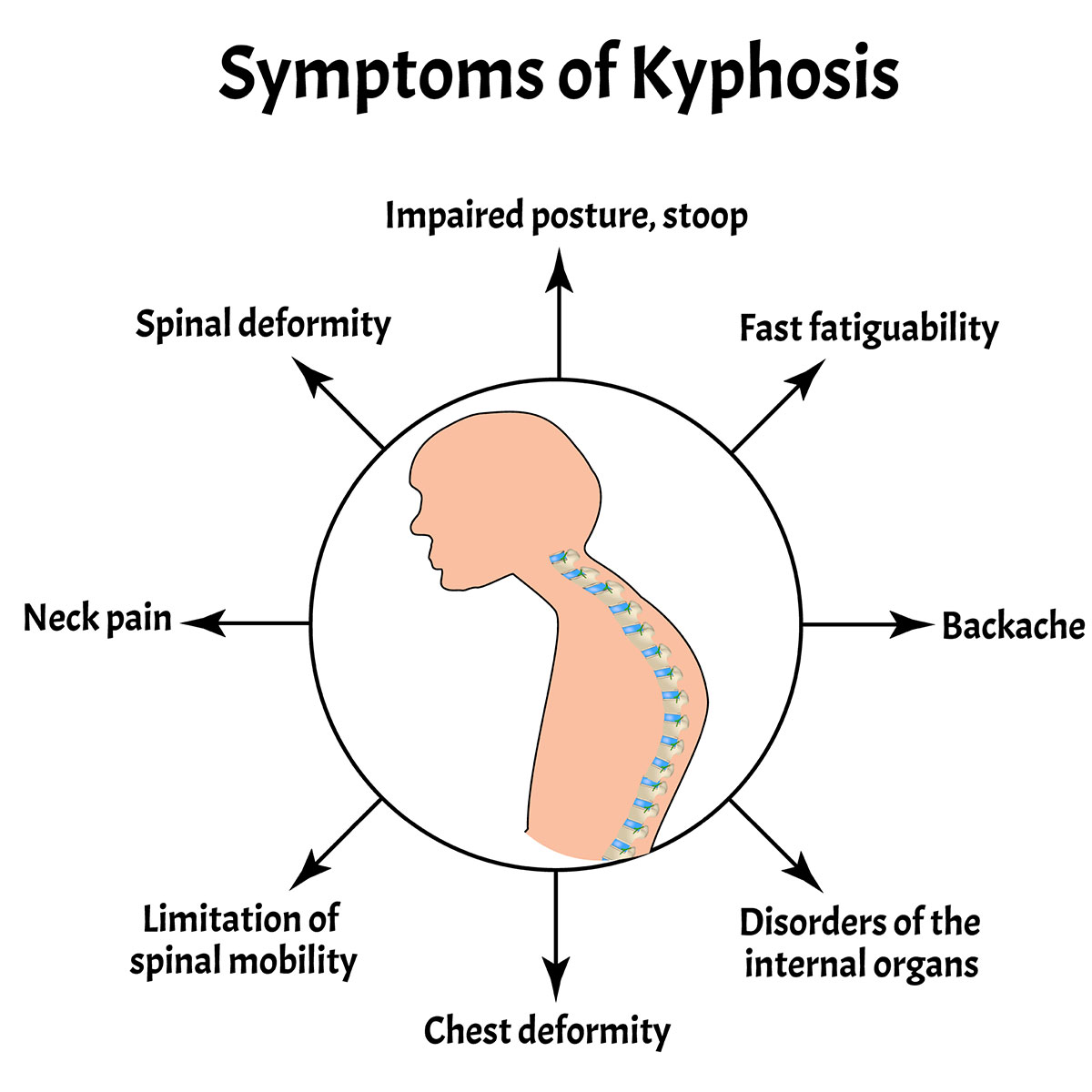 Kyphosis Vejthani Hospital