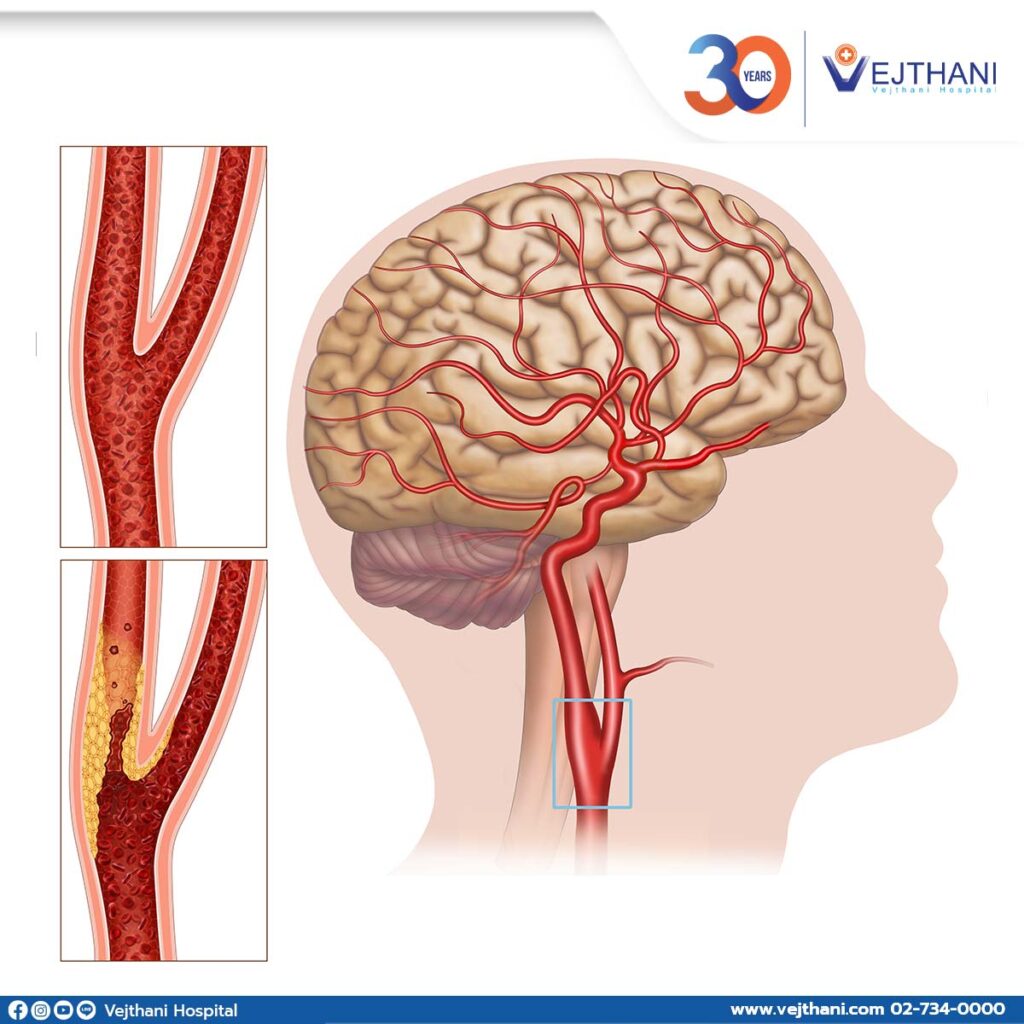 Carotid Artery Treatment Vejthani Hospital