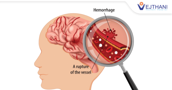 Brain Hemorrhage What You Need To Know