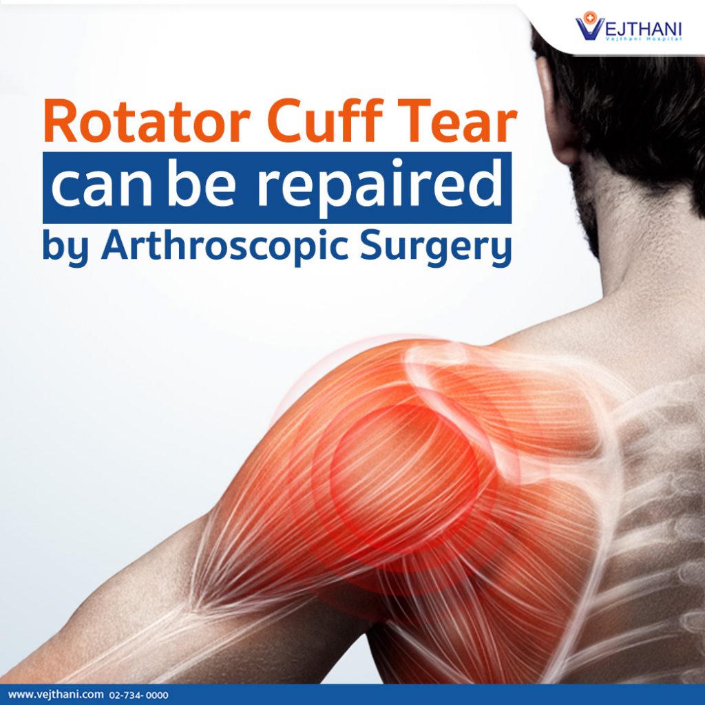 Rotator Cuff Tear Can Be Repaired By Arthroscopic Surgery Vejthani Hospital