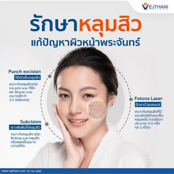 รักษาหลุมสิว แก้ปัญหาผิวหน้าพระจันทร์ - Vejthani Hospital