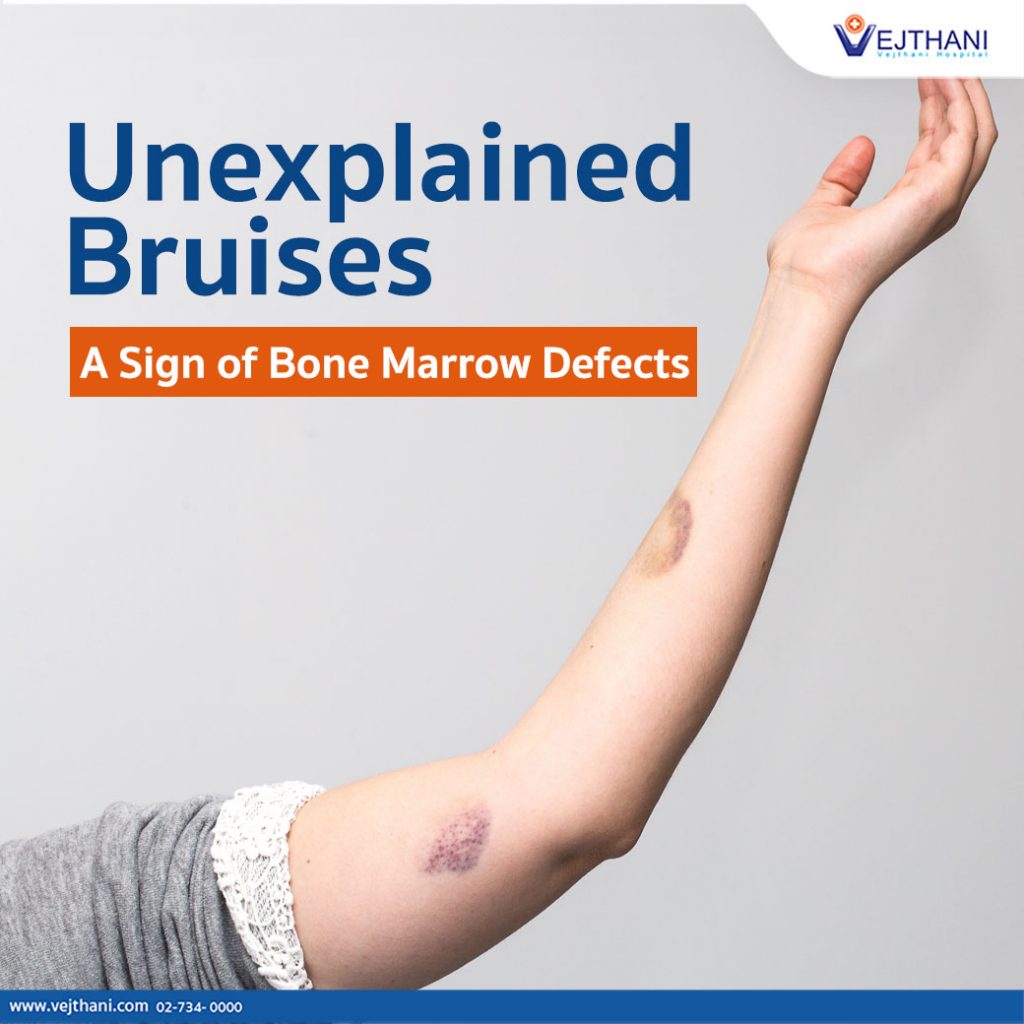 unexplained-bruises-a-sign-of-bone-marrow-defects-vejthani-hospital