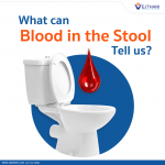 What can Blood in the Stool Tell us?