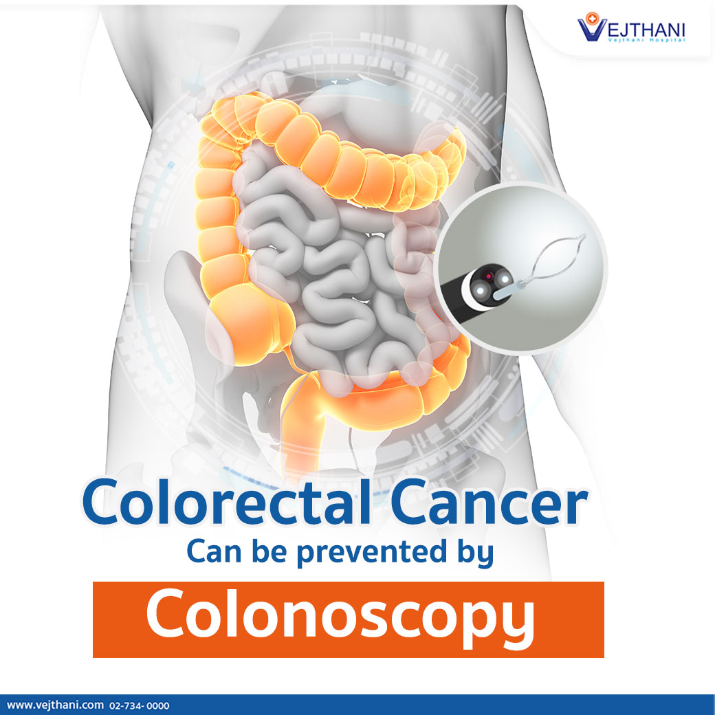 Colorectal Cancer Can be prevented by Colonoscopy