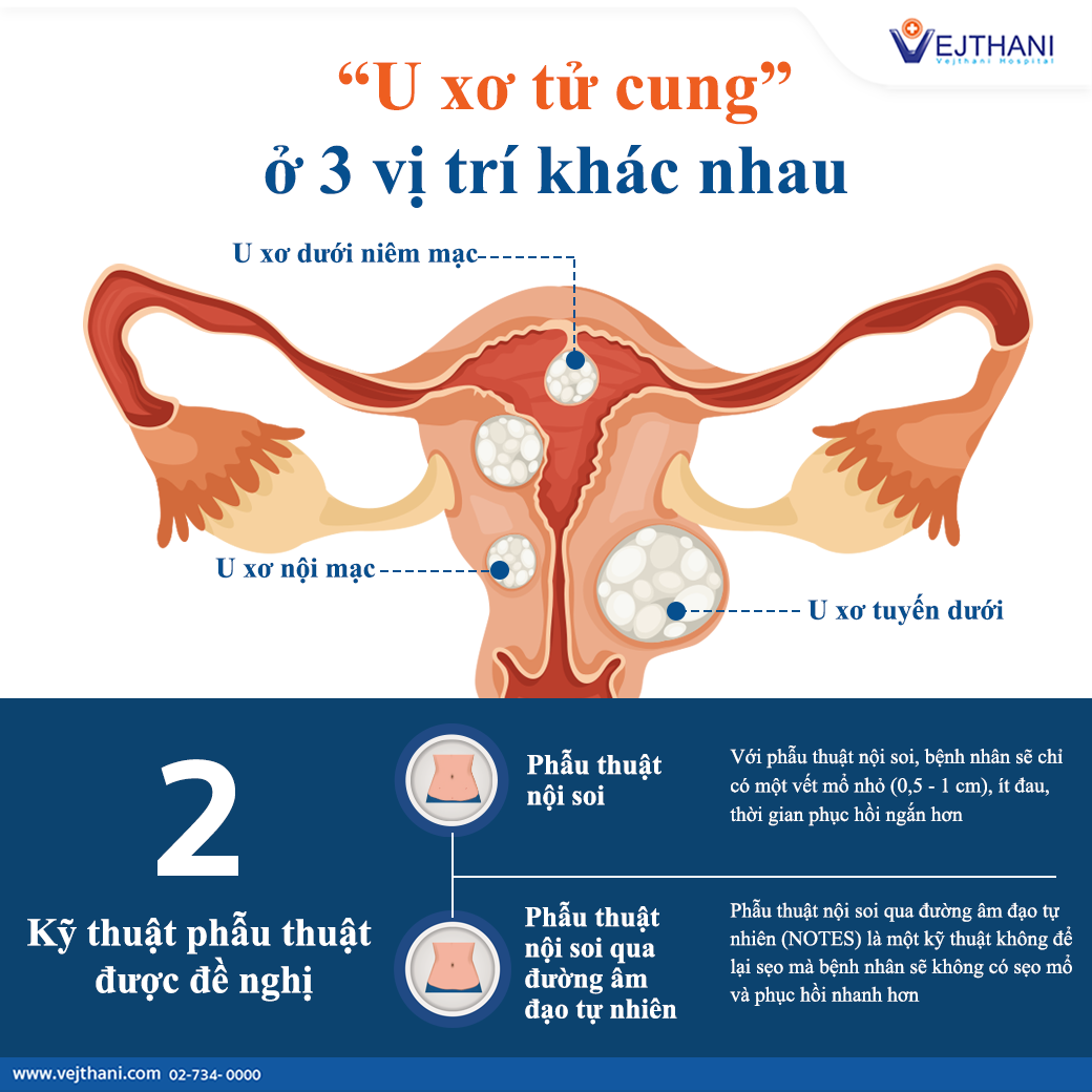 Sự khác biệt của u xơ tử cung ở 3 vị trí khác nhau