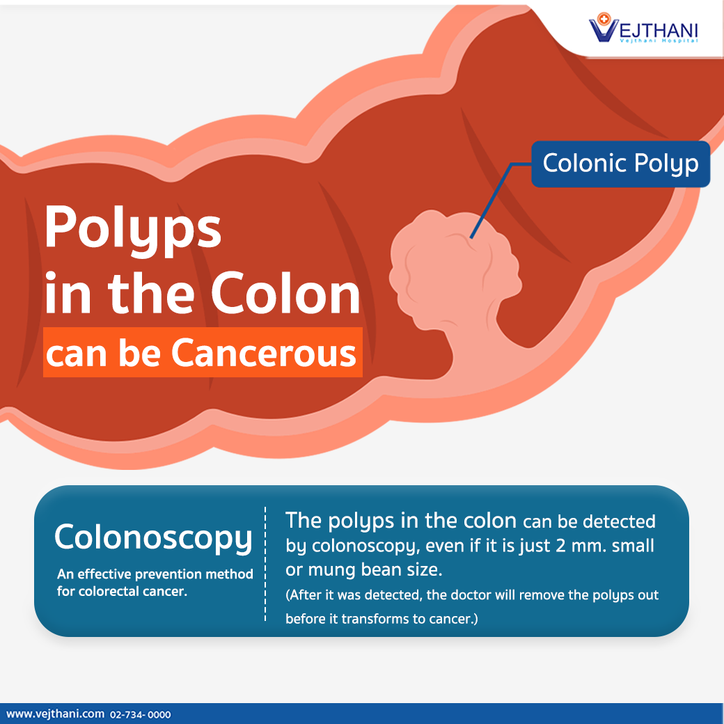 Colon Polyps Definition Risk Factors Symptoms Of Colon