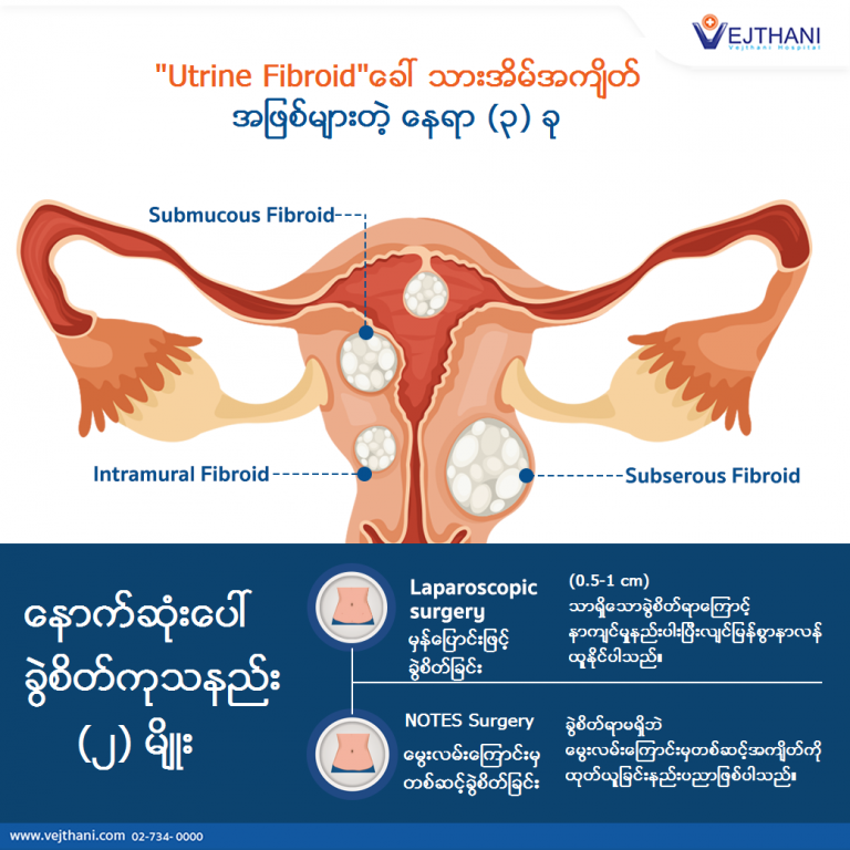 Uterine Fibroid သ သအမအကတ တဟ အမသမတ Vejthani Hospital JCI Accredited