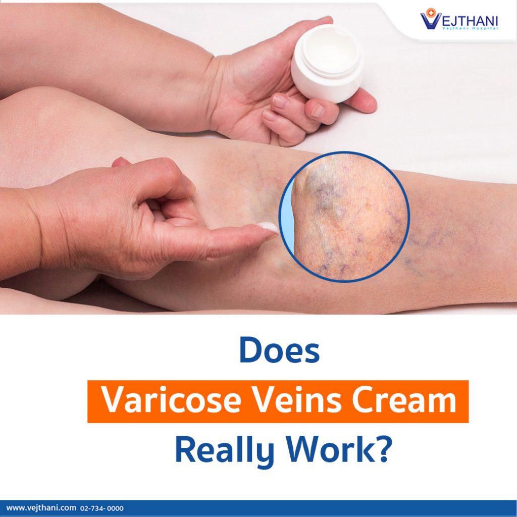 How to fix varicose veins and spider veins?