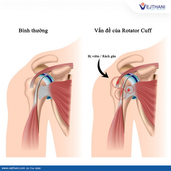 Điều Trị Hiệu Quả Cho Hội Chứng Chạm Mỏm Cùng Vai Vejthani Hospital