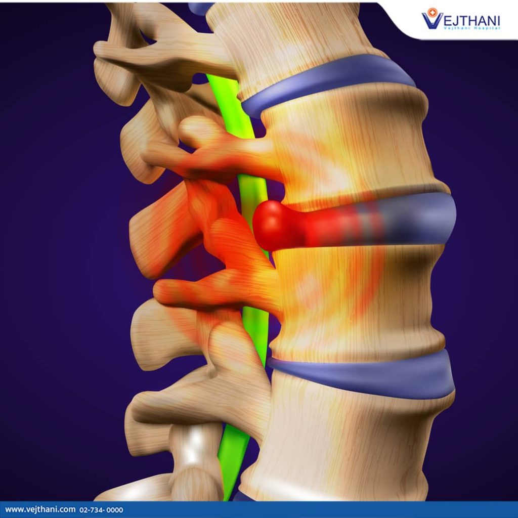 View of a herniated disc that requires treatment.