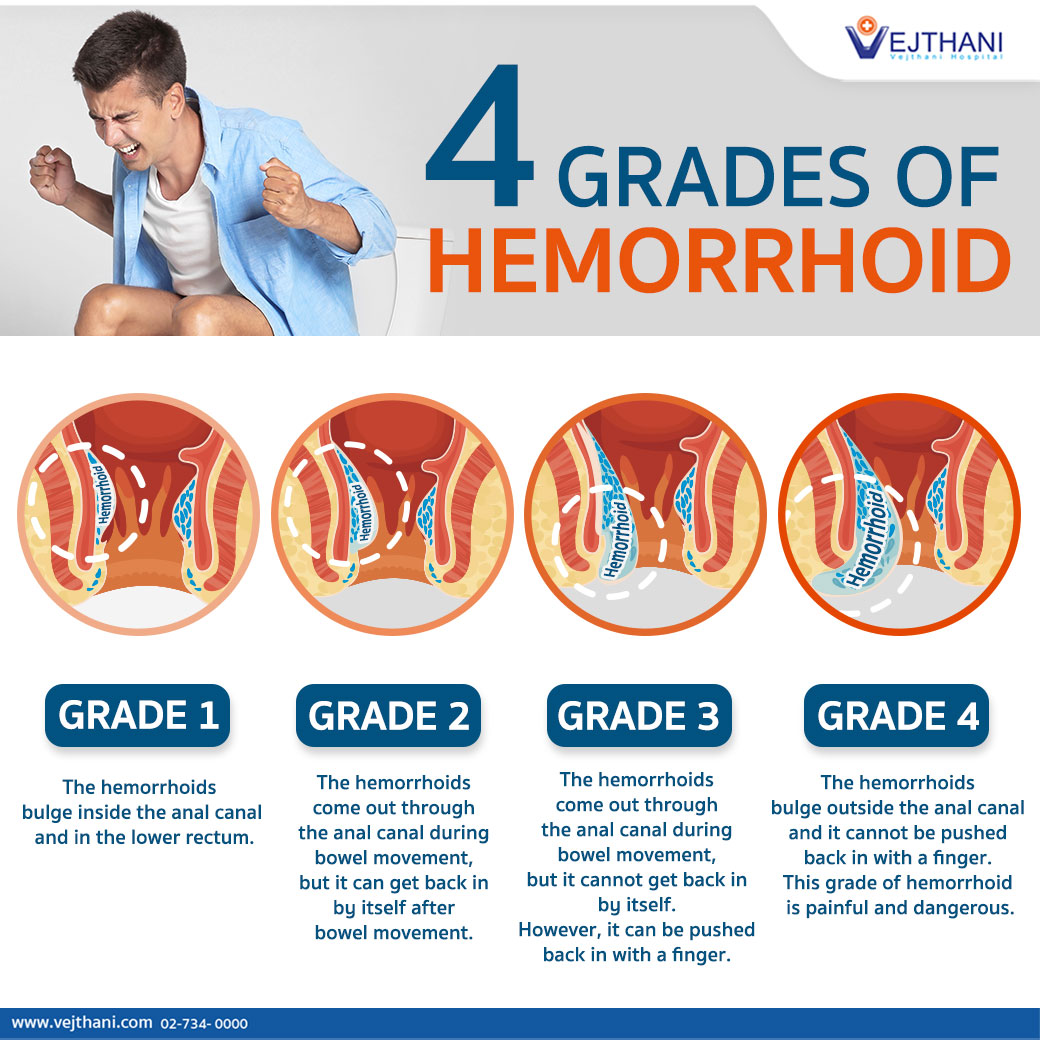 Do you have hemorrhoids? How severe is your hemorrhoid? Vejthani