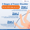 3 Stages of Frozen Shoulder – Find out which stage you are in