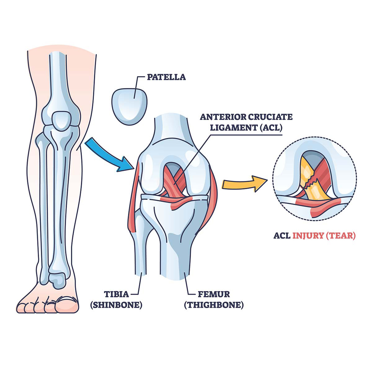 ACL Tear, ACL Injuries Symptoms & Signs