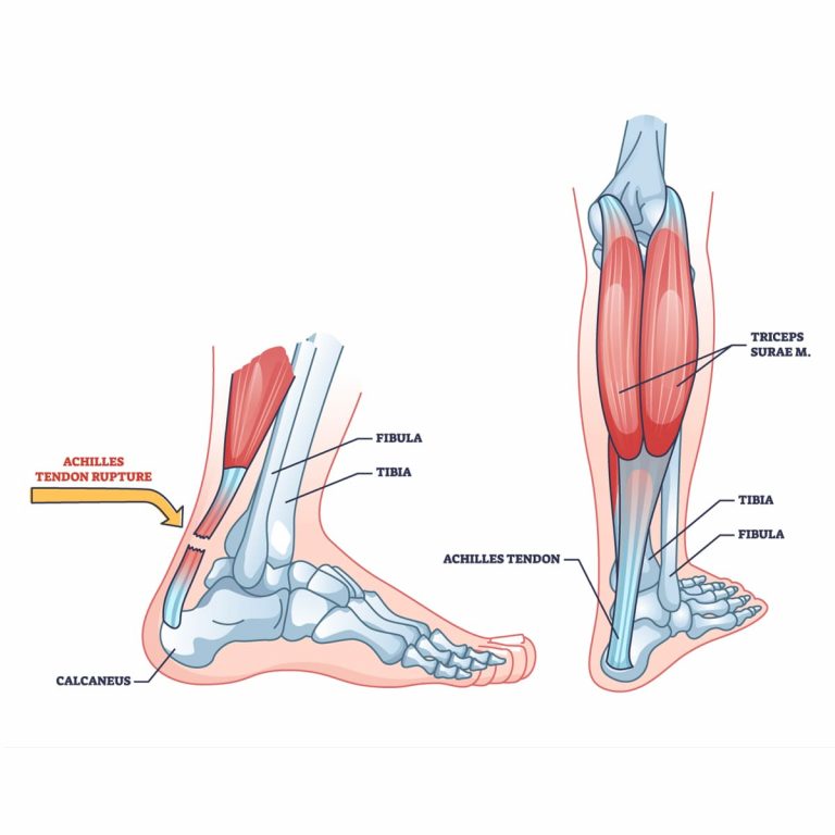 Achilles tendon rupture - Vejthani Hospital | JCI Accredited ...