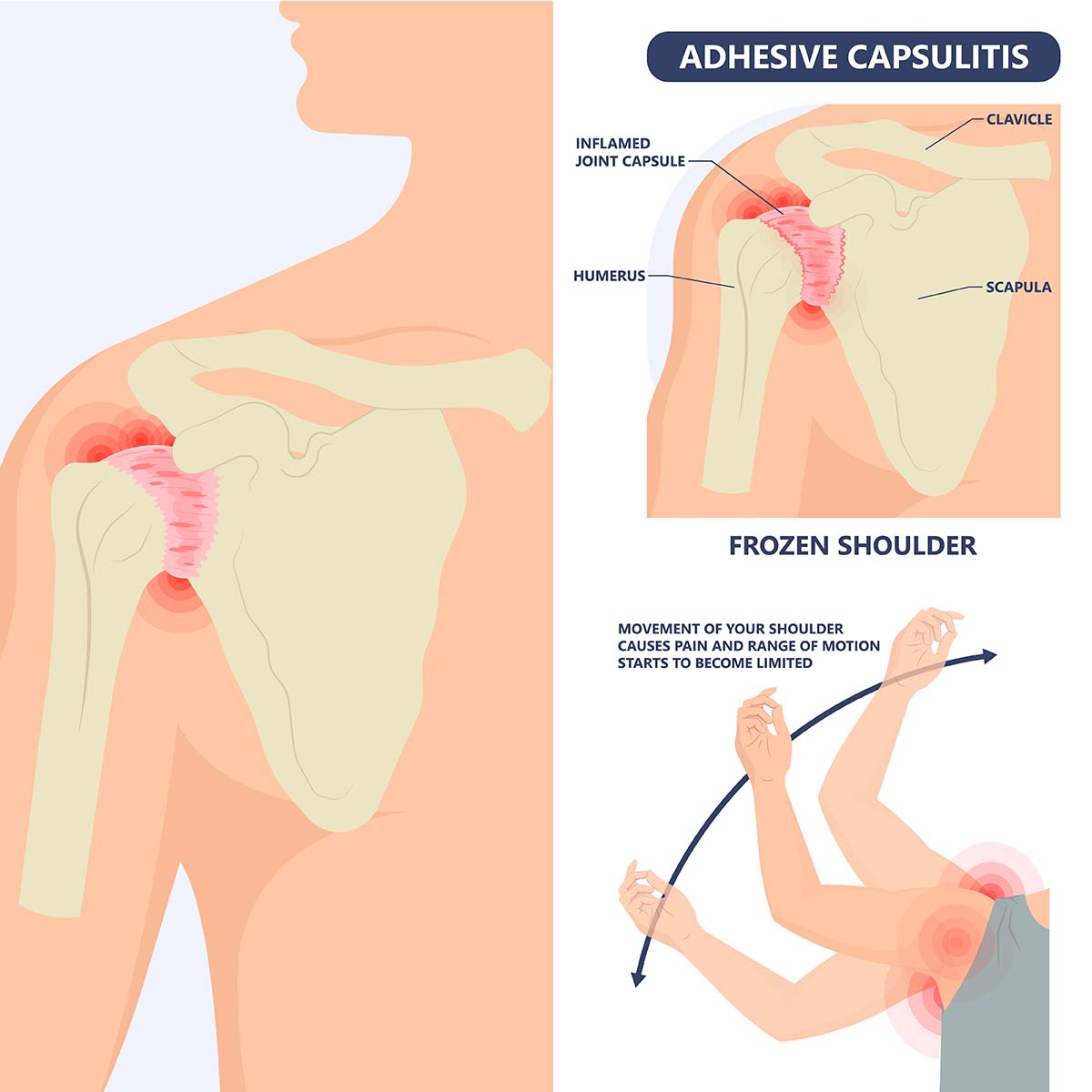 Frozen Shoulder