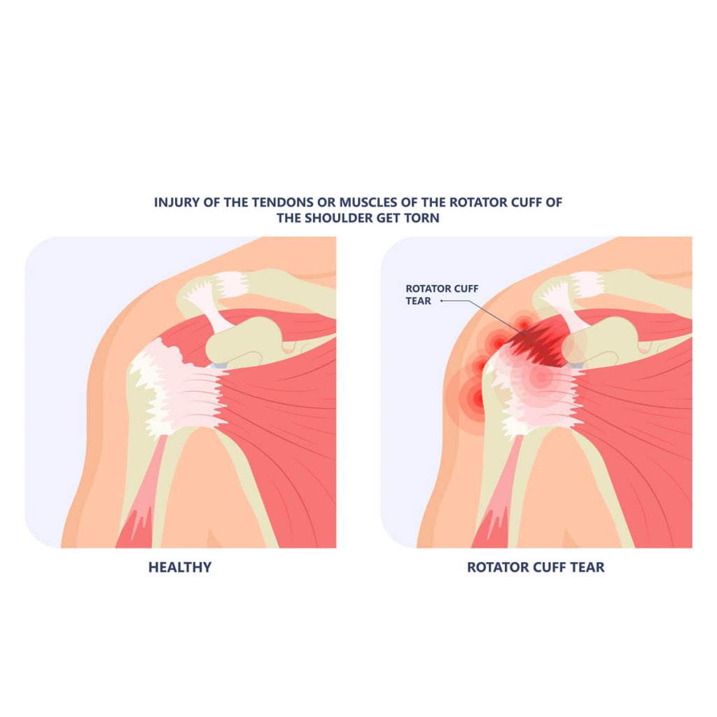 Treatment Methods for Rotator Cuff Tears - Vejthani Hospital