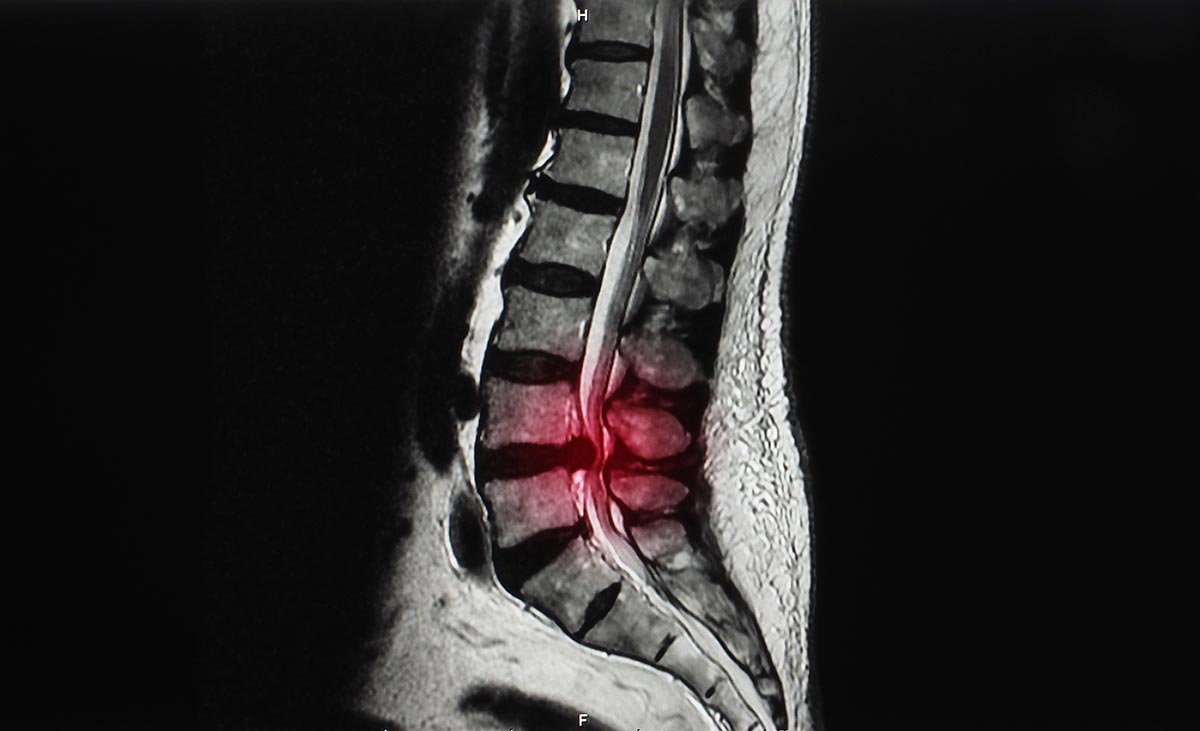 Spinal Stenosis: Lumbar