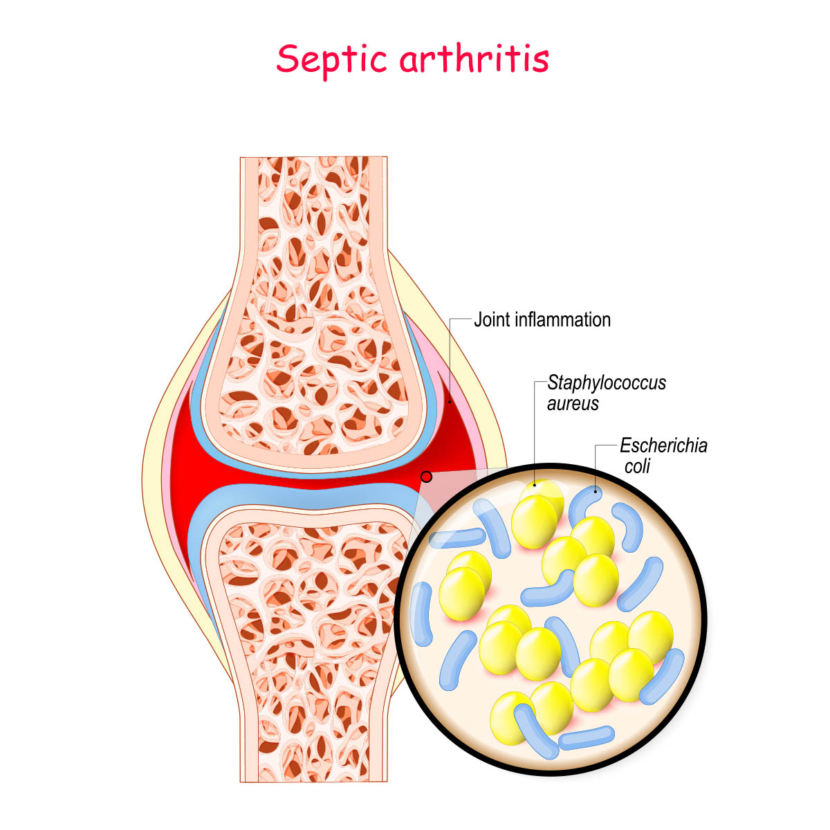 6 Risk Factors Of Septic Arthritis You Must Know Vejthani 5364