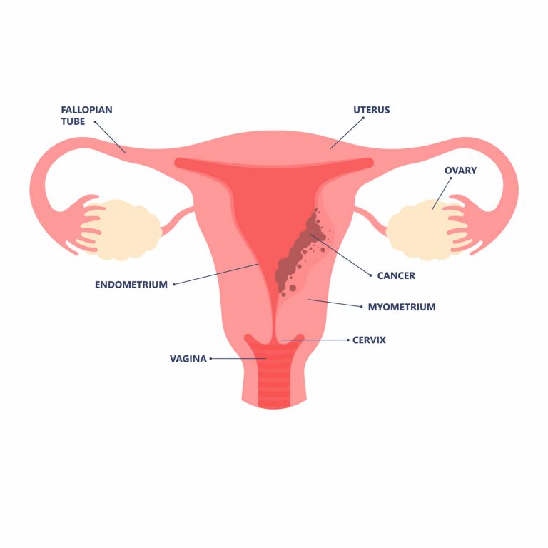 Endometrial Cancer Symptoms Causes And Treatments Vejthani 2941