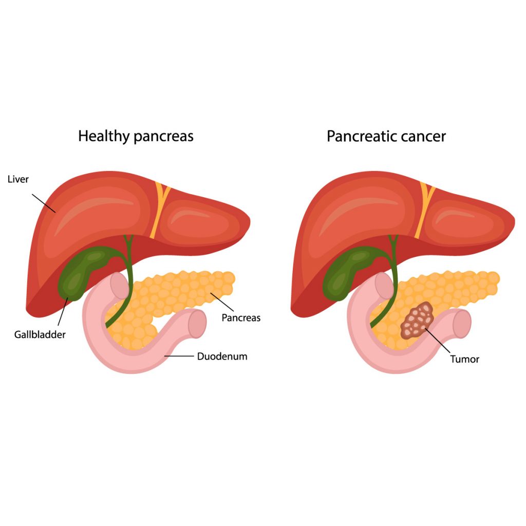 The 2024 Guide to Pancreatic Cancer Treatments | Vejthani