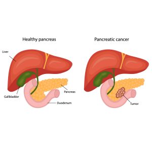 Pancreatic cancer - Vejthani Hospital | JCI Accredited International ...