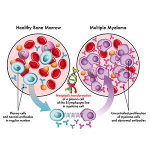 8 Crucial Multiple Myeloma Symptoms To Watch For | Vejthani