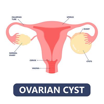 uterus cyst