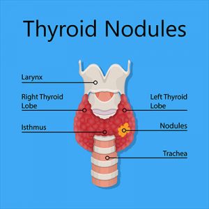 Thyroid nodules - Vejthani Hospital | JCI Accredited International ...