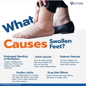 What Causes Swollen Feet?