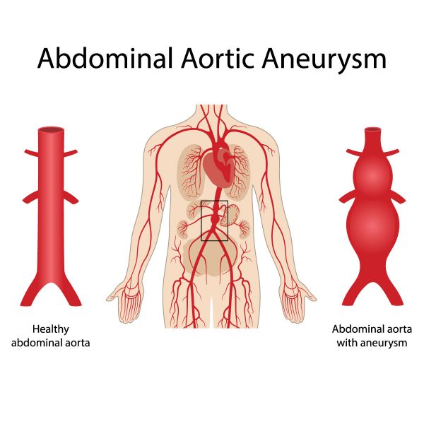 Abdominal aortic aneurysm - Vejthani Hospital | JCI Accredited ...