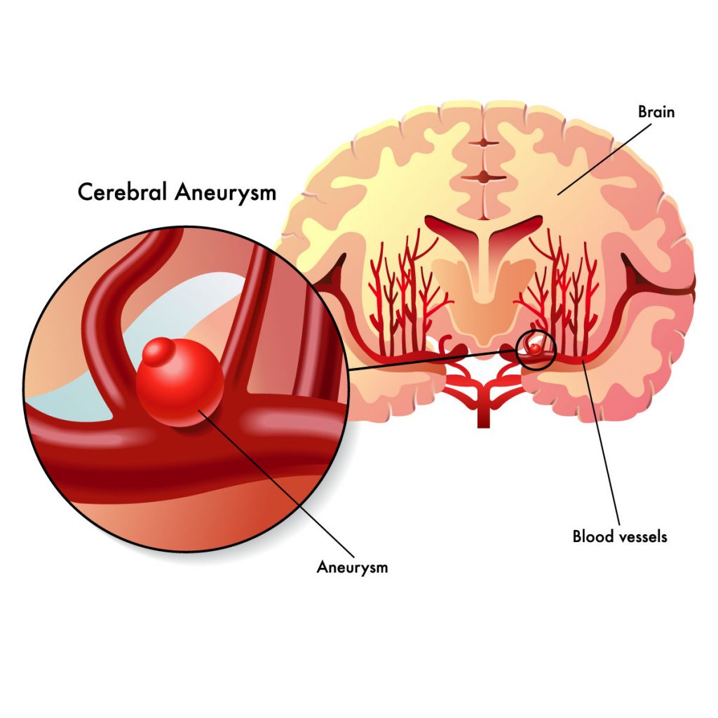 Aneurysm - Vejthani Hospital | JCI Accredited International Hospital in ...