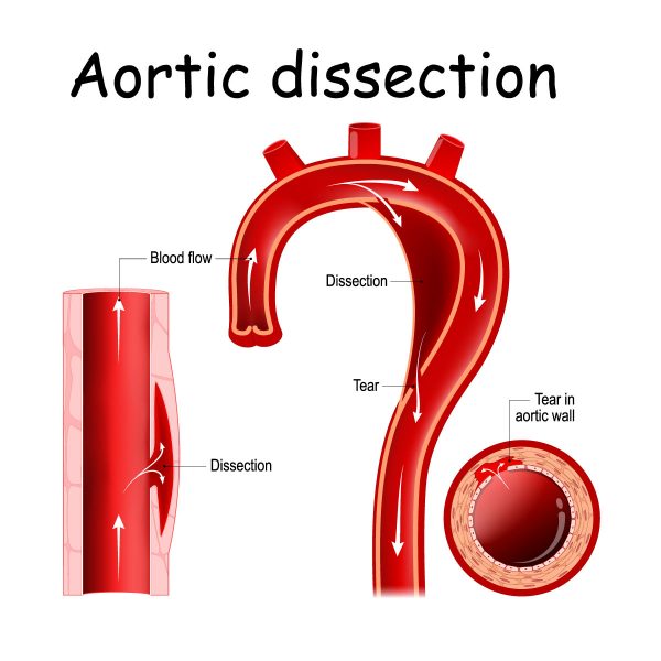 Aortic Dissection Risks and 8 Critical Symptoms | Vejthani