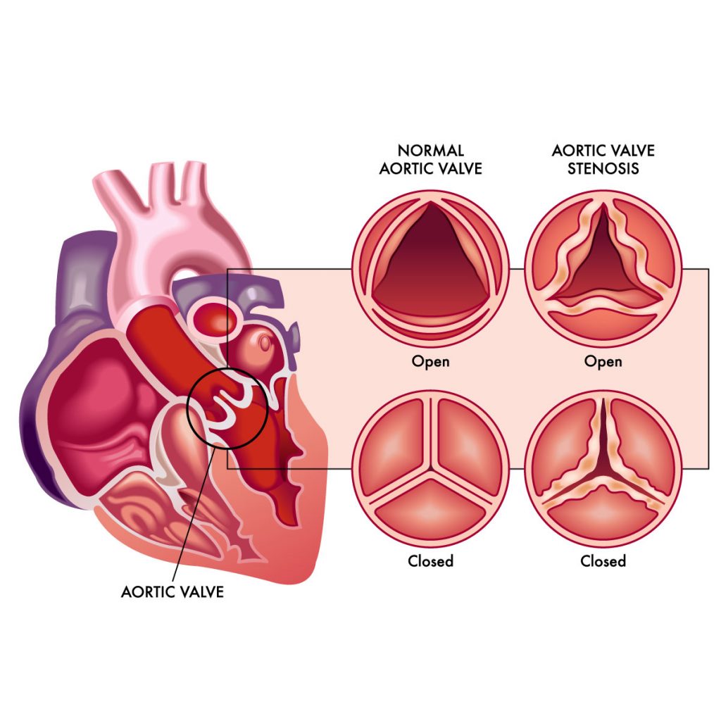 Aortic valve disease Vejthani Hospital JCI Accredited International