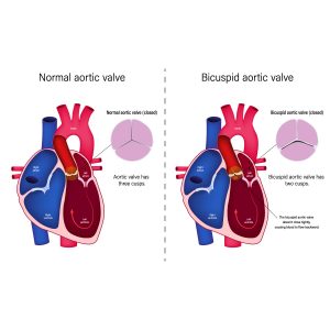 8 Common Symptoms For Aortic Valve Regurgitation | Vejthani