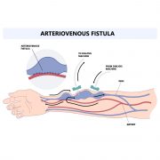 2024 Guide: Arteriovenous Fistula Causes & Cares | Vejthani