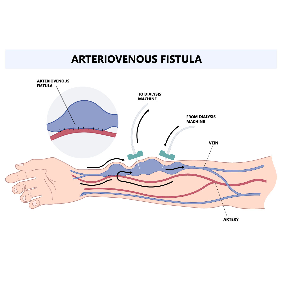 2024 Guide Arteriovenous Fistula Causes Cares Vejthani