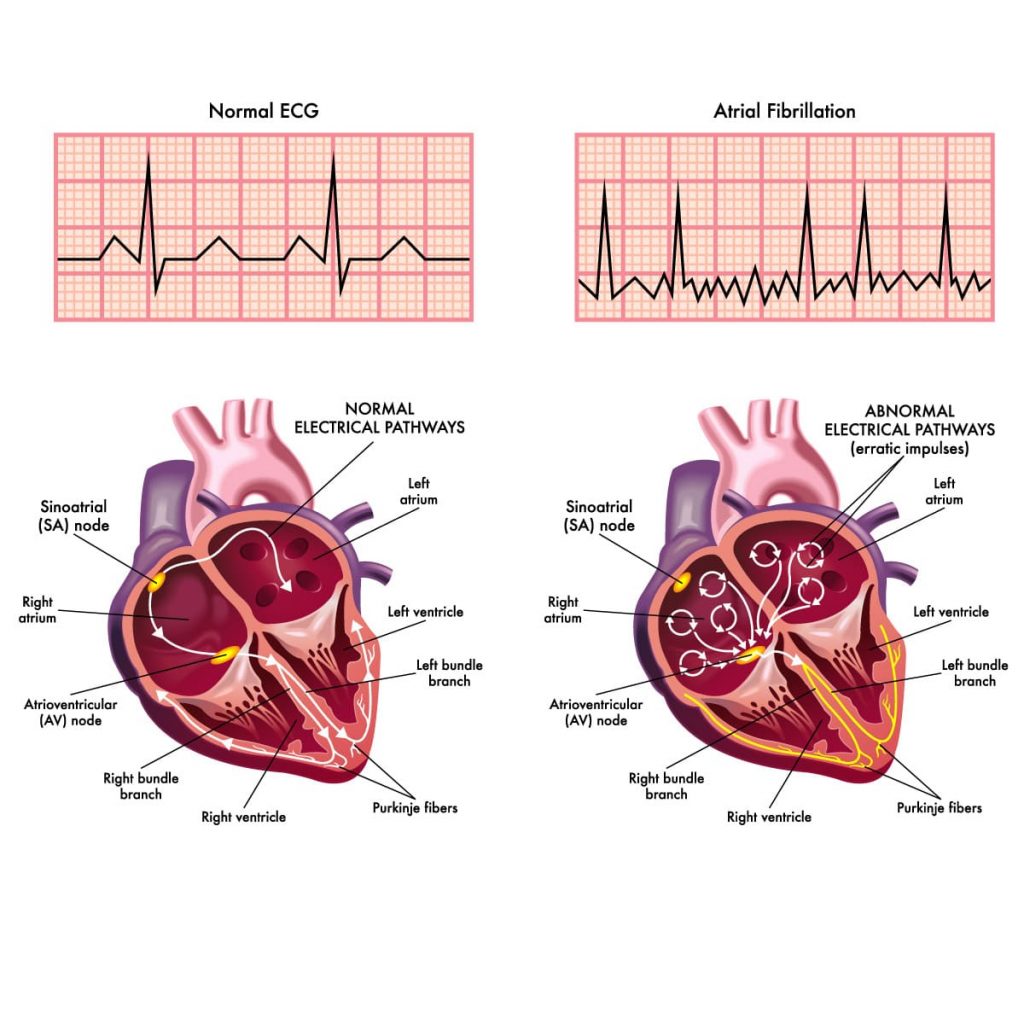 atrial-fibrillation-vejthani-hospital-jci-accredited-international