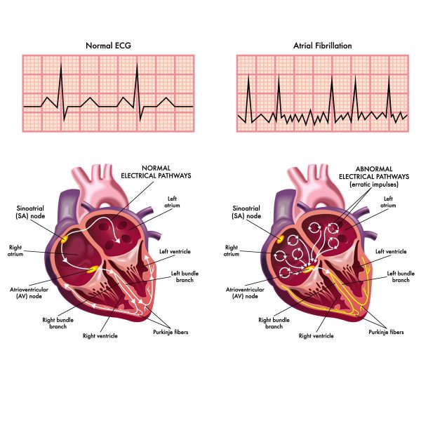 Atrial fibrillation - Vejthani Hospital | JCI Accredited International ...