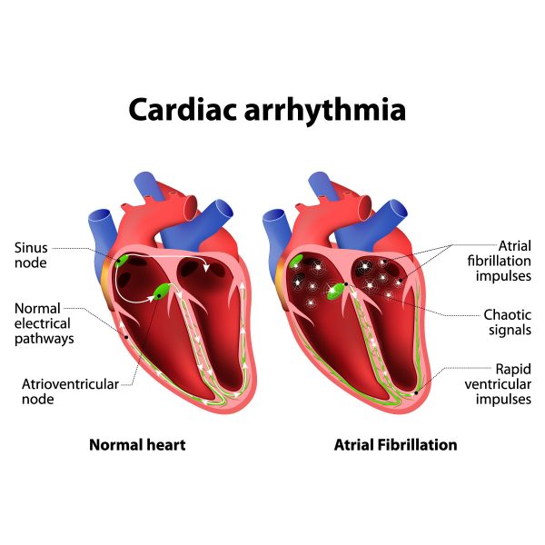 How Serious Is Heart Arrhythmia? Learn More | Vejthani