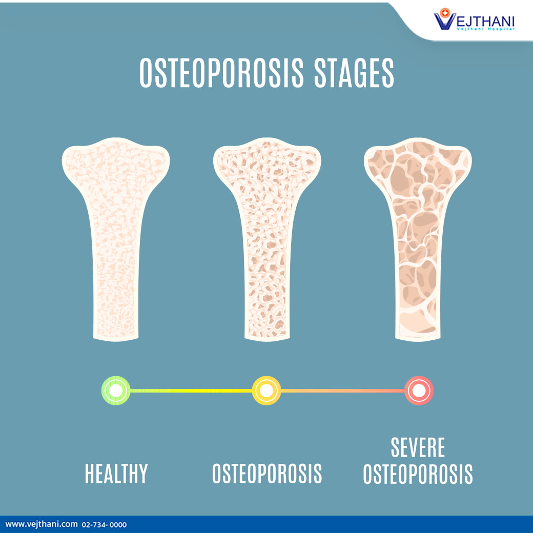 Diagnostic Tests For Osteoporosis