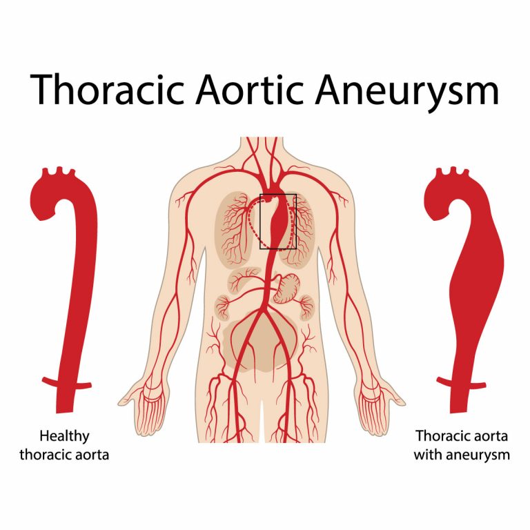 Aortic Aneurysm Vejthani Hospital Jci Accredited International