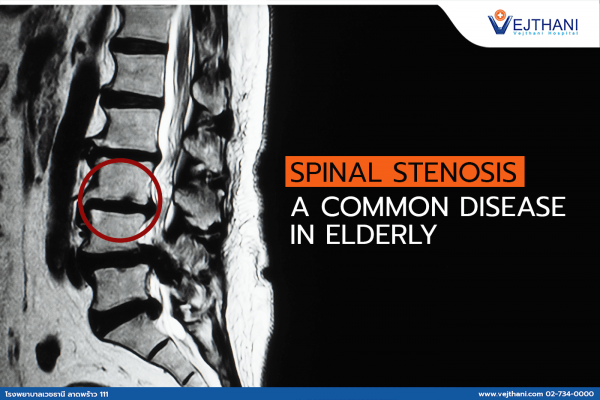 Spinal Stenosis – A Common Disease in Elderly