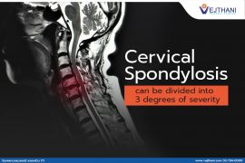 3 Degrees of Severity for Cervical Spondylosis