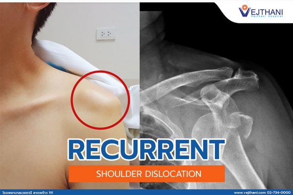 “recurrent Shoulder Dislocation” Is Treatable 1848