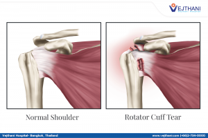 Treatment Methods For Rotator Cuff Tears