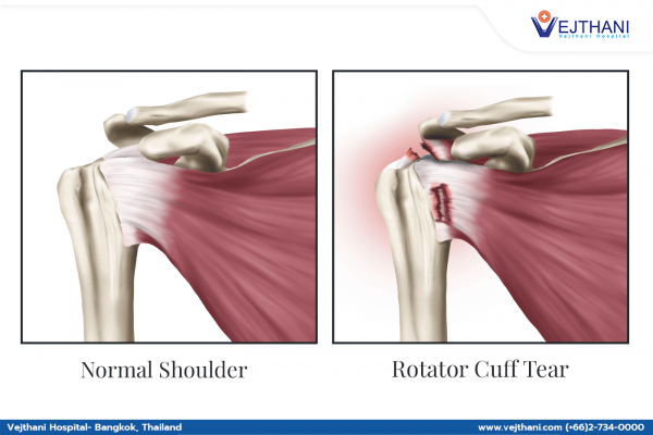 Treatment Methods for Rotator Cuff Tears