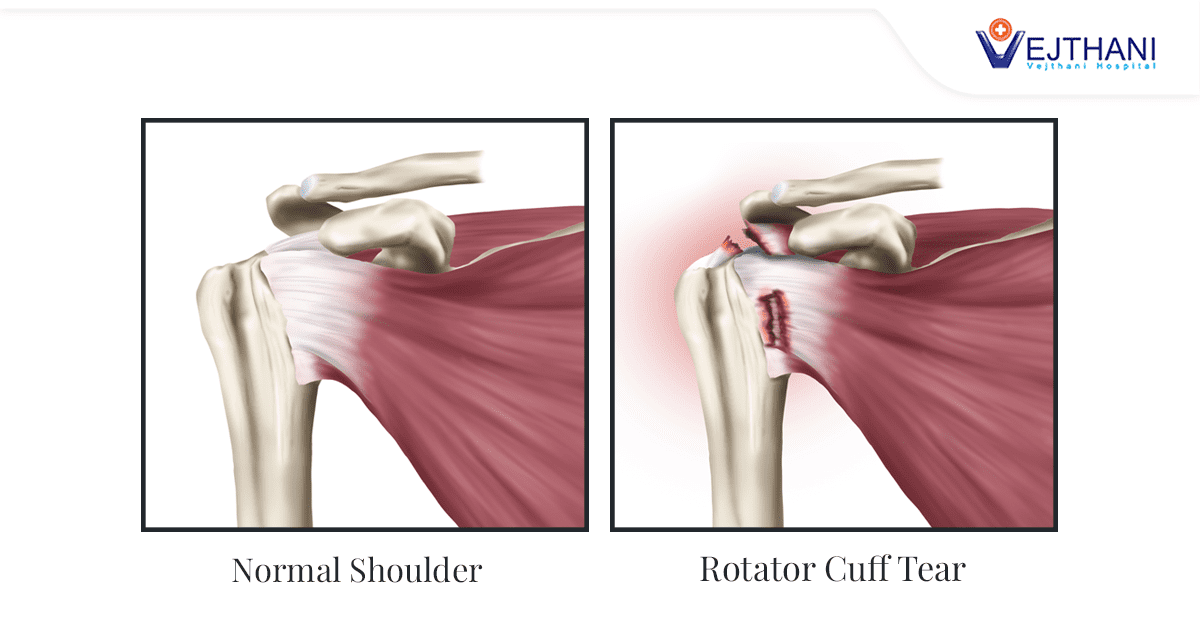 https://www.vejthani.com/wp-content/uploads/2023/03/Thumbnail-Treatment-Methods-for-Rotator-Cuff-Tears-1.png