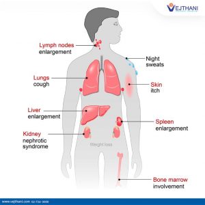 Lymphoma Treatment in Thailand | Vejthani Hospital