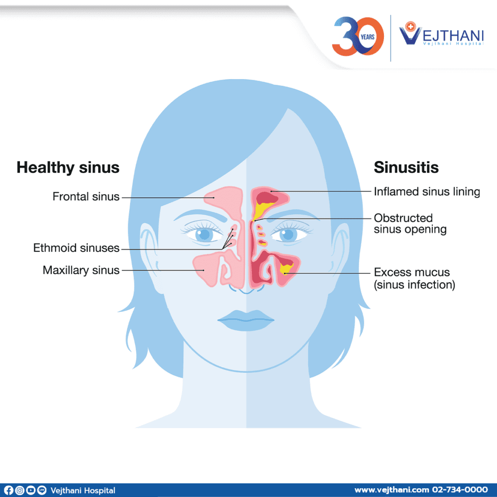 Chronic Sinusitis - Vejthani Hospital | JCI Accredited International ...