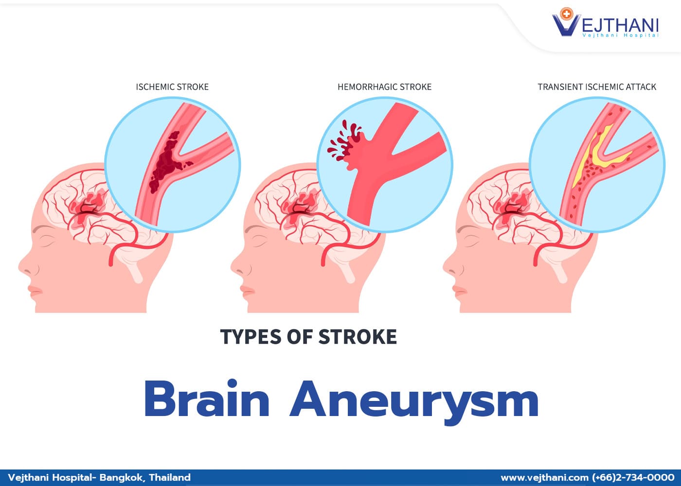 Overview of Brain Aneurysm - Vejthani Hospital | JCI Accredited ...